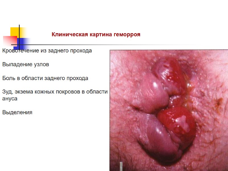 Клиническая картина геморроя Кровотечение из заднего прохода  Выпадение узлов  Боль в области